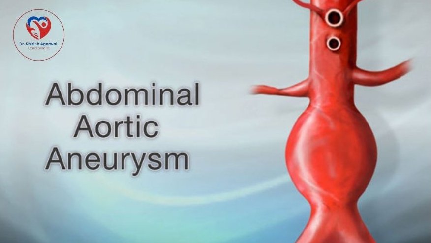 Illustration of an Abdominal Aortic Aneurysm with a bulge in the aorta, representing a cardiovascular condition