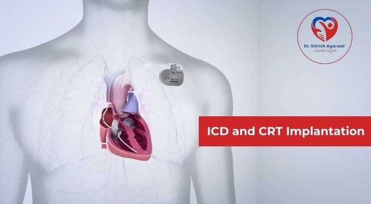 Illustration of an ICD and CRT device implanted in a human chest, highlighting implantation procedures.