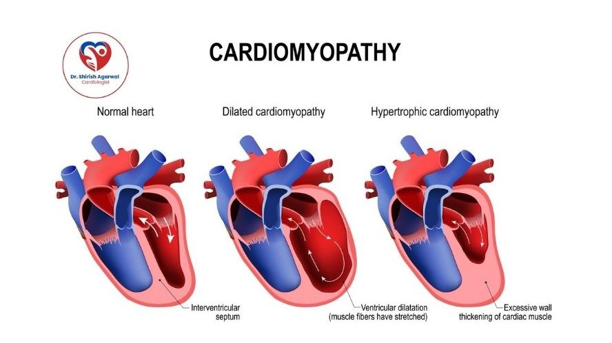 Illustration of three heart models showing normal, dilated cardiomyopathy, and hypertrophic cardiomyopathy conditions.