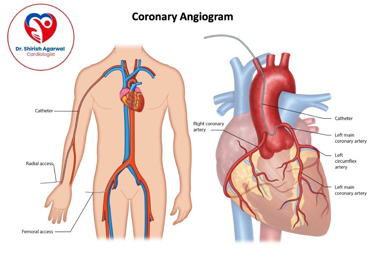 Illustration of a Coronary Angiogram procedure showing catheter insertion and arteries of the heart.