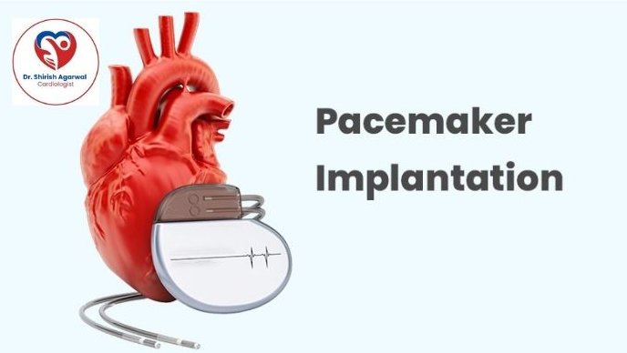 Illustration of a heart with a pacemaker device, highlighting pacemaker implantation.