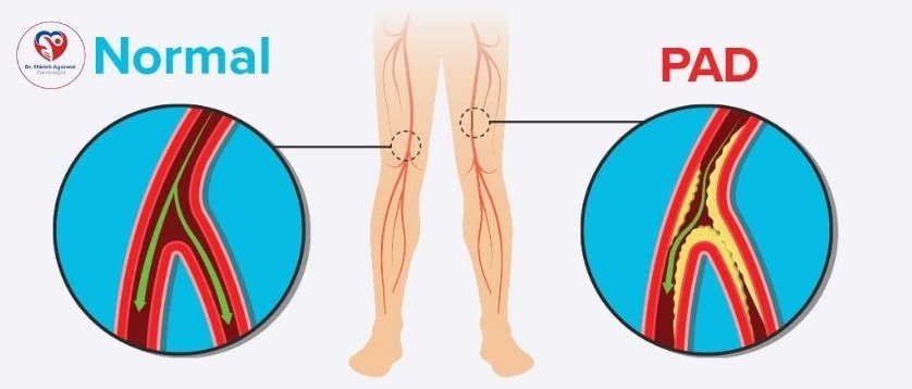 A comparison between normal arteries and arteries affected by Peripheral Artery Disease (PAD) in the legs.