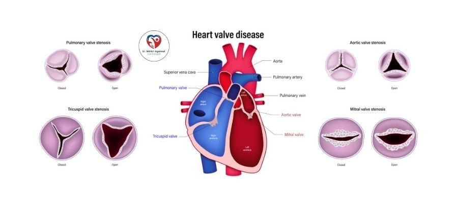 Illustration showing Valvular Heart Disease different types of heart valve stenosis, affecting pulmonary, tricuspid, aortic, and mitral valves.